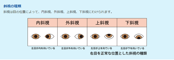 画像 ののかちゃん 左目は斜視で手術や矯正で治る 怖いという声も 村方乃々佳 Trend Diary